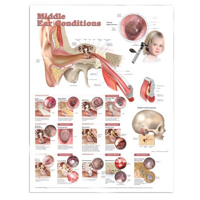 Poster "Middle Ear Conditions" Laminated